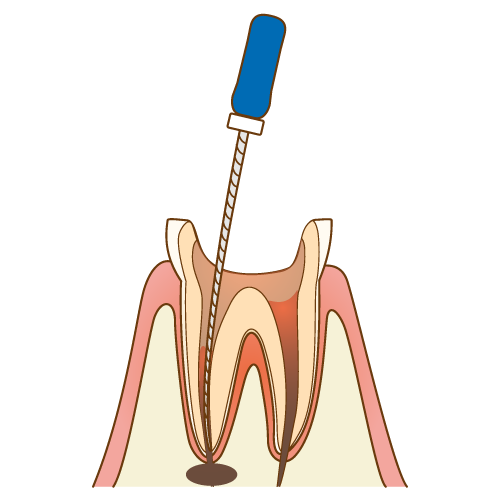神経がないのになぜ痛む？根管治療の原因と対処法を解説