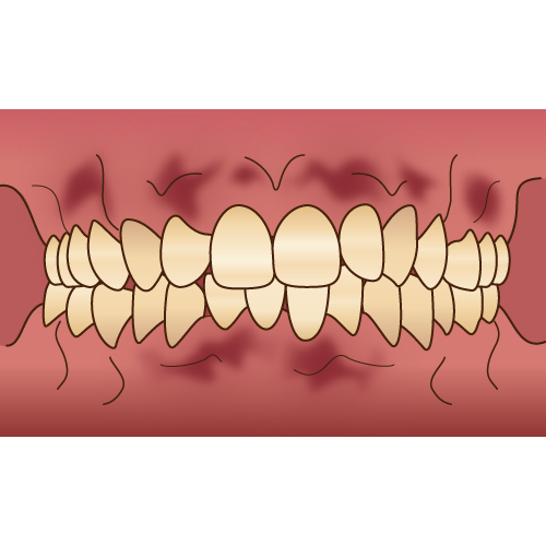 歯茎の着色の原因と対処法を解決