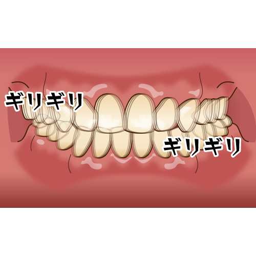 歯ぎしりの原因と放置した場合の悪影響を解説