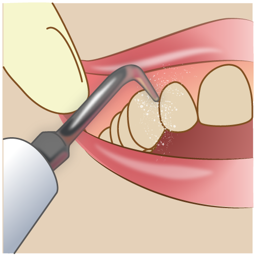 歯石除去のメリット・デメリットとは？