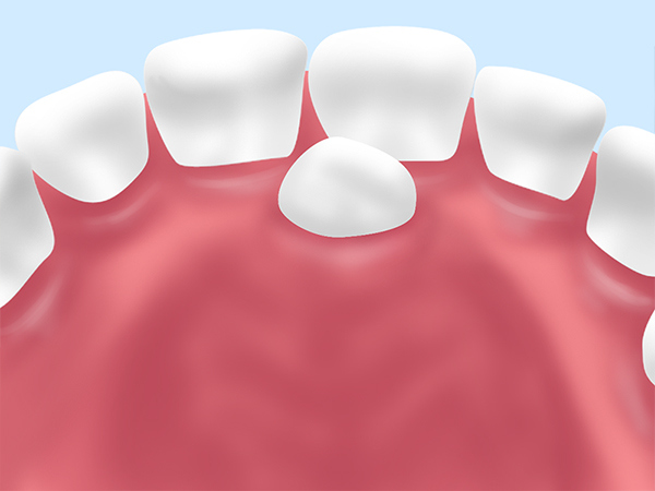 「過剰歯」の抜歯にも対応します