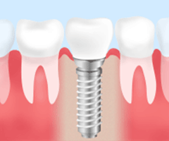 インプラント