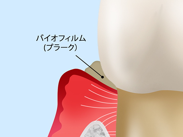 歯が抜け落ちてしまう？歯周病の原因とは