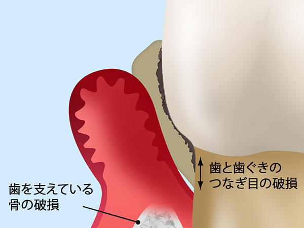 歯が抜け落ちてしまう？歯周病の原因とは