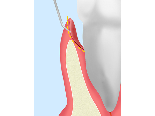 歯周ポケット掻爬術